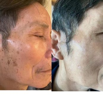 Spot & pigmentation