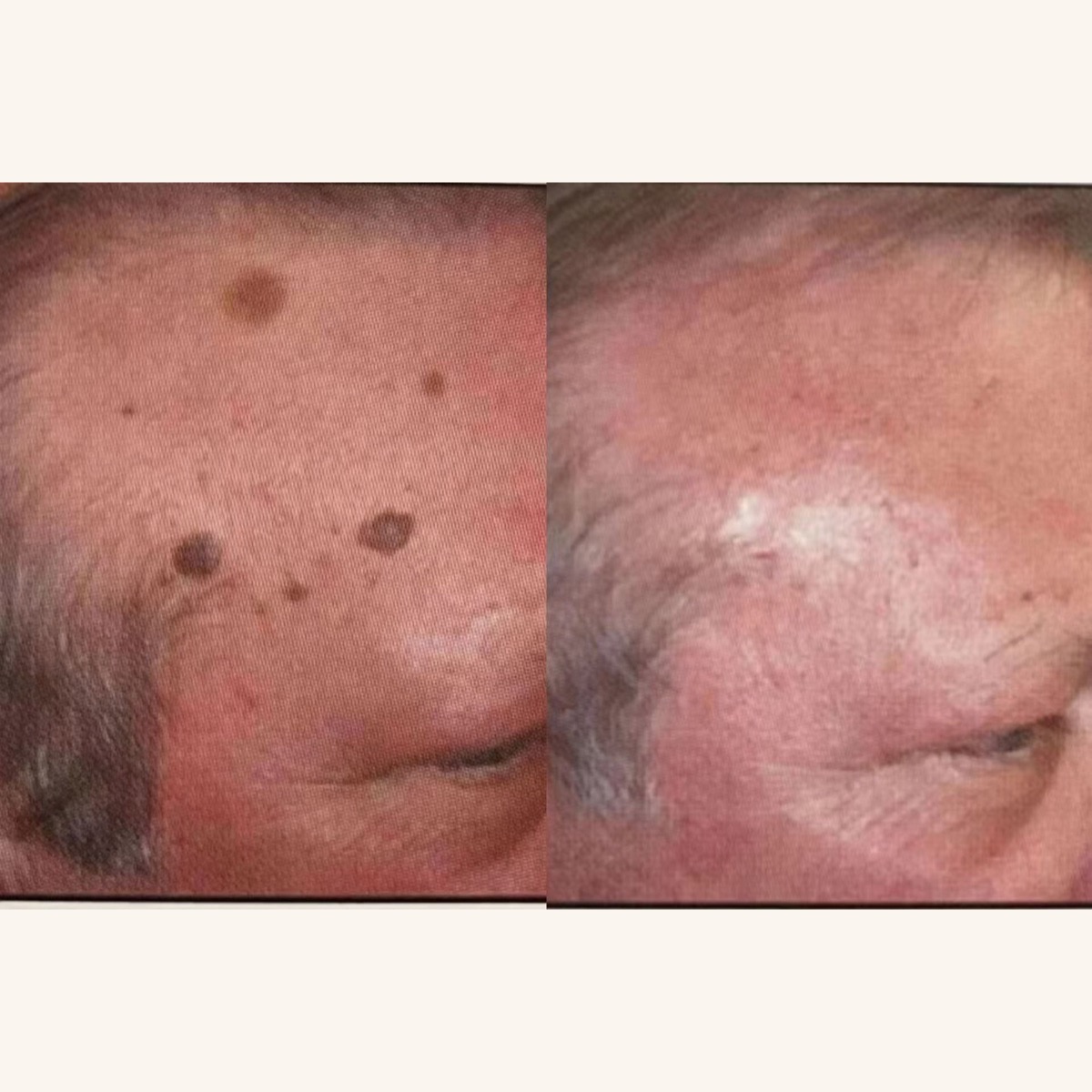 Mole removal 点痣