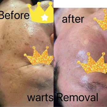 Skin renewal