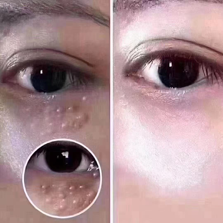 Eye-area renewal